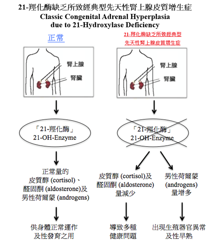 21-羥化酶缺乏所致經典型先天性腎上腺皮質增生症圖解